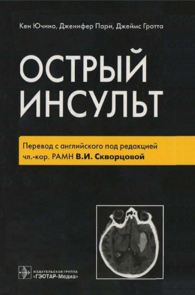К. Ючино. Острый инсульт
